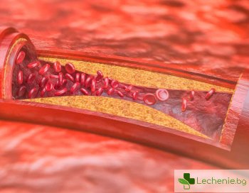 Полезна информация за атеросклероза