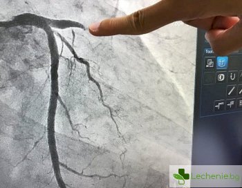 Коронарография - защо е необходимо изследването