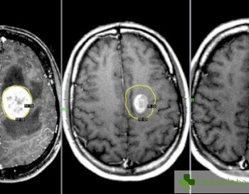 Рак на главния мозък - как да не пропуснете първите симптоми