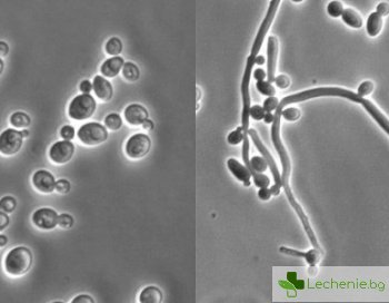 Как да унищожим гъбичката кандида? 