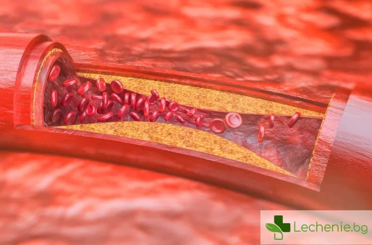 Полезна информация за атеросклероза