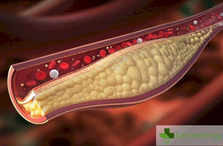 Лечение на атеросклероза
