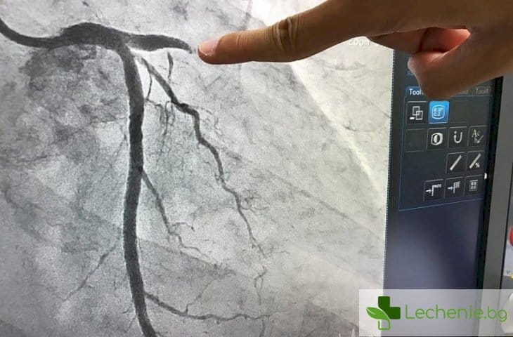 Коронарография - защо е необходимо изследването