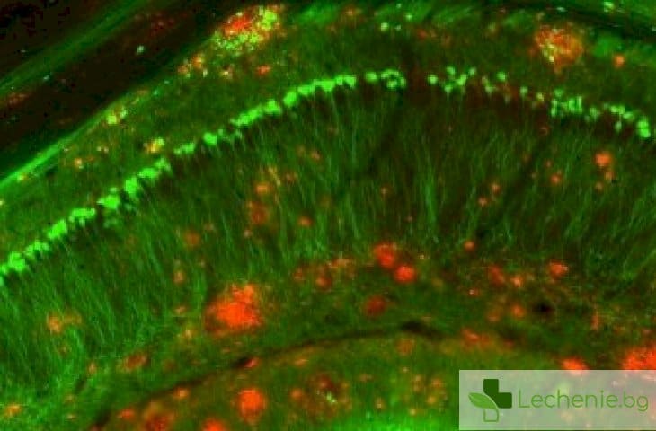 Нова протеинова инжекция ликвидира Алцхаймер само за 1 седмица