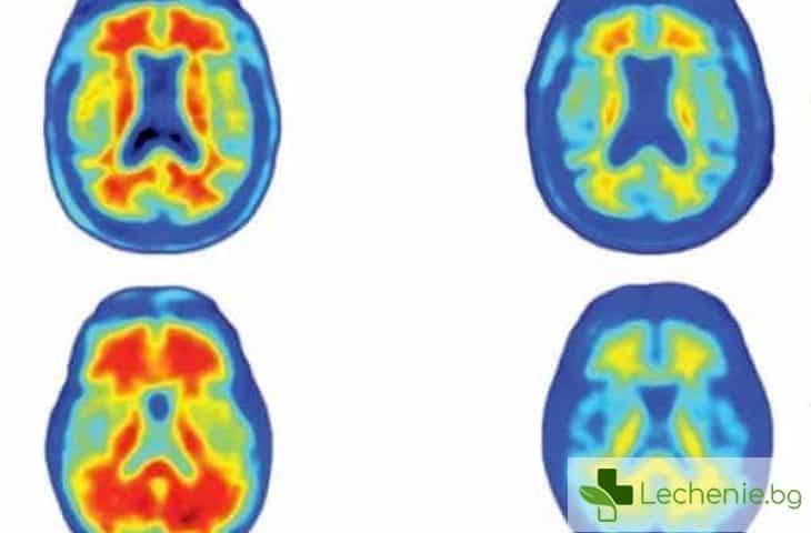 Ново лекарство премахва токсичните протеини от мозъка на болни от Алцхаймер