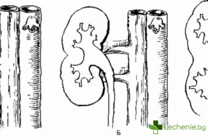 Всичко, което е важно да знаете за удвояването на бъбречното легенче