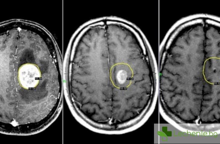 Рак на главния мозък - как да не пропуснете първите симптоми