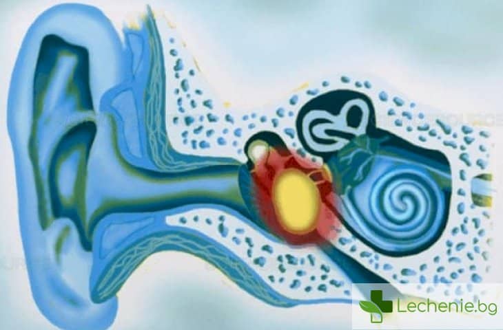 Гноен отит - причини и симптоми на гнойно възпаление на ухото