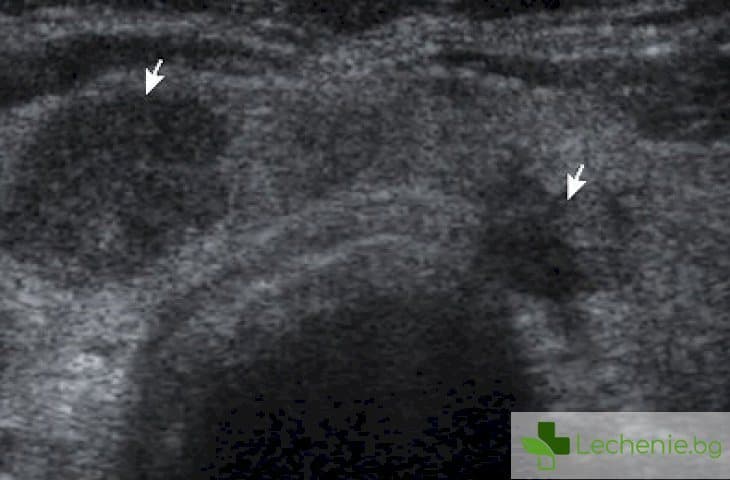 Хипоехогенни образувания - какво точно представляват, къде се появяват най-често