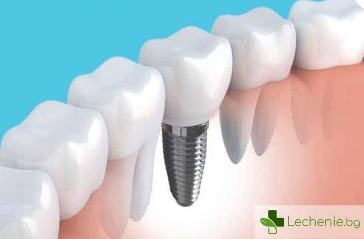 Антидепресантите увеличават риска от отхвърляне на зъбните импланти